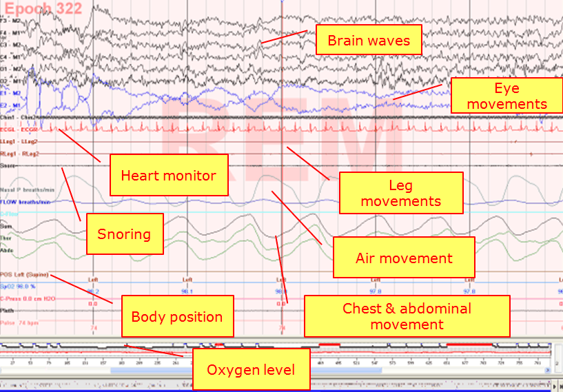 1 Hour of Sleep vs No Sleep: Sleep Study Results Explained